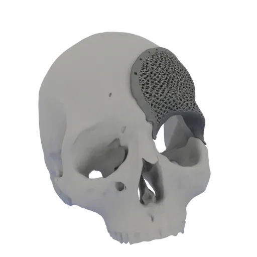 Modelo 3D de um crânio humano com um implante craniano customizado e estruturado em treliça, ajustado sobre a área do osso te