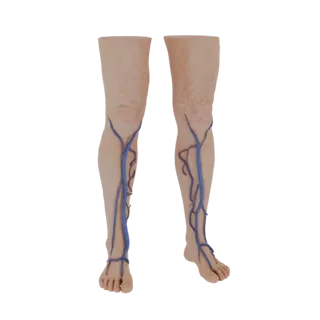 Modèle 3D de jambes féminines atteintes de varices prononcées, veines bleu-violet visibles sur les mollets et les tibias.