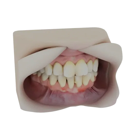 3D model of human upper and lower teeth, showing inflamed red gums and visible plaque, indicating gingivitis.