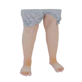 نموذج ثلاثي الأبعاد لأرجل بشرية تظهر حالة جلدية على الركبة وعلامات حمراء على الساقين.